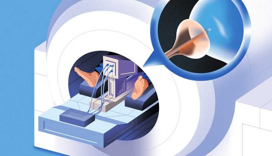 The SMART™ Prostate Cancer Procedure: What and Who It’s For