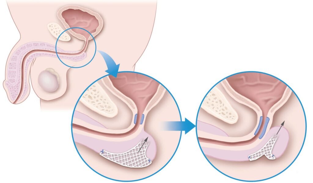 How to Achieve Zero Incontinence After Prostate Removal: The SMART Approach